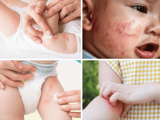 Gentle Rash Relief: How Mighty Propolis Salve Can Soothe Your Baby's Skin